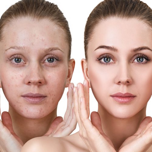 Acne Facial Facial Bar NY